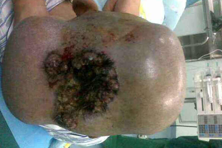 小孩皮肤癌头烂图