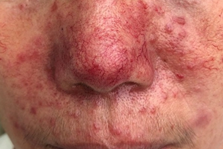 丘疹脓疱型酒糟鼻鼻部红斑图