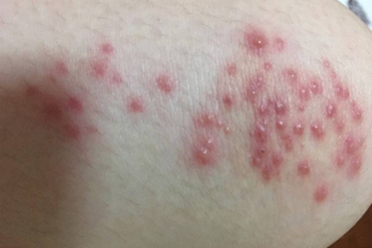 茶毛虫皮炎大腿水疱图