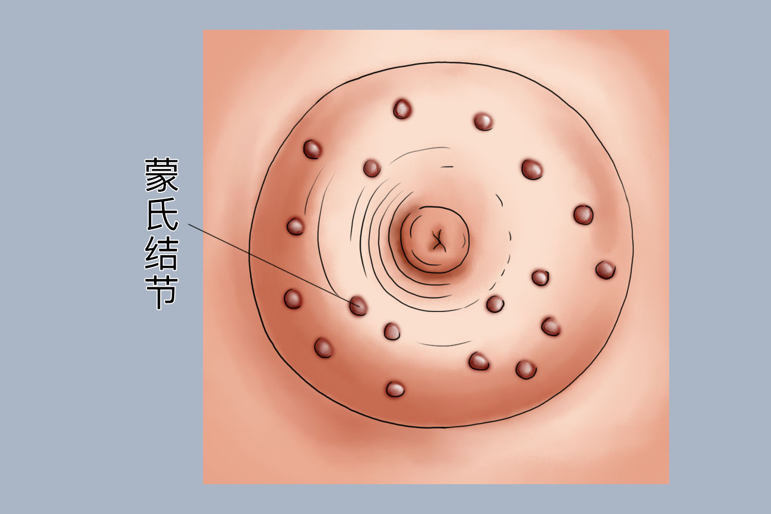 正常乳房蒙氏结节初期图片