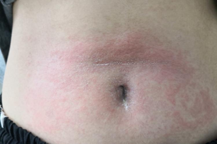 光毒性接触性皮炎腹部红斑图