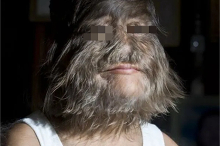 女性多毛症面部症状图