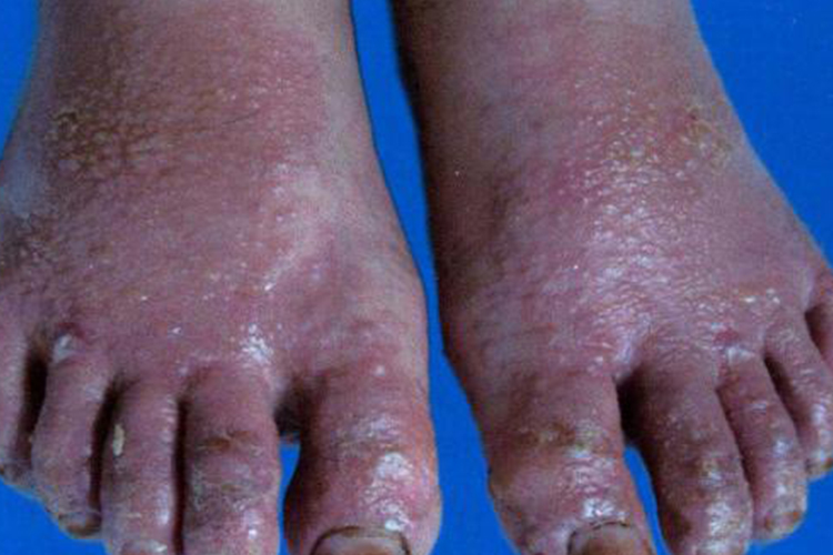 足部急性湿疹图 足部急性湿疹图