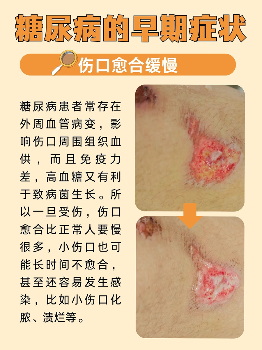 警惕！这些可能是糖尿病早期症状⚠️