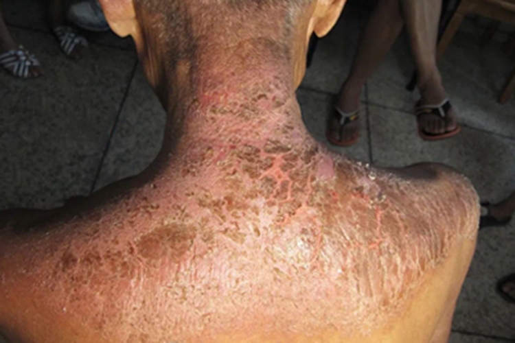 慢性接触性皮炎背部结痂图 慢性接触性皮炎背部结痂图