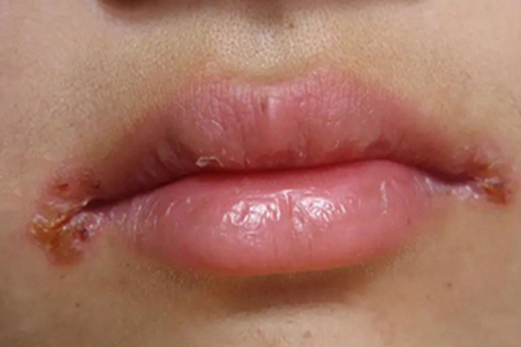 创伤性口角炎口角裂口图