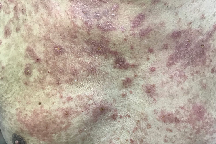 亚急性湿疹-暗红色皮损图