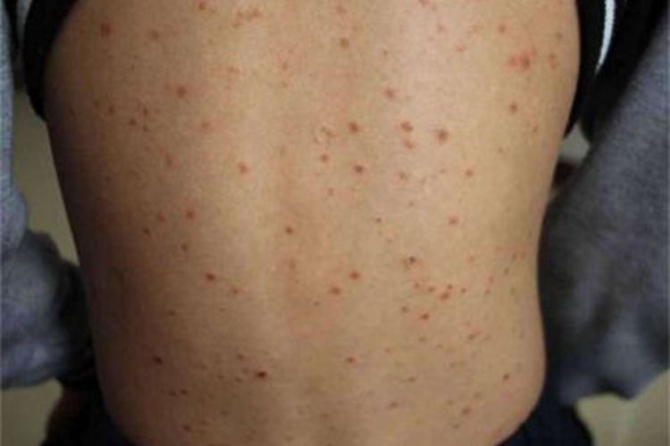 急性痘疮样苔藓样糠疹小红疙瘩图 急性痘疮样苔藓样糠疹小红疙瘩图