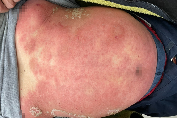 毒性红斑全身症状图 毒性红斑全身症状图