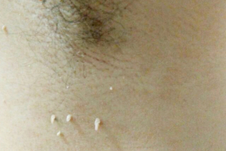 寻常疣腋下白色突起小疙瘩图