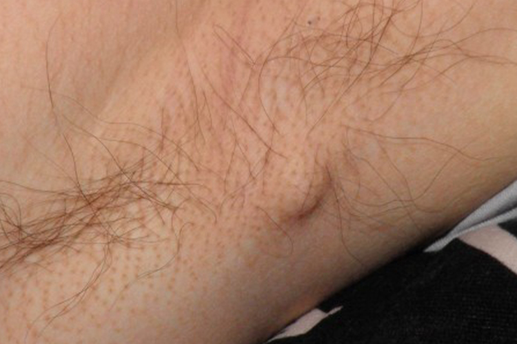 乳腺癌腋下淋巴结肿大图