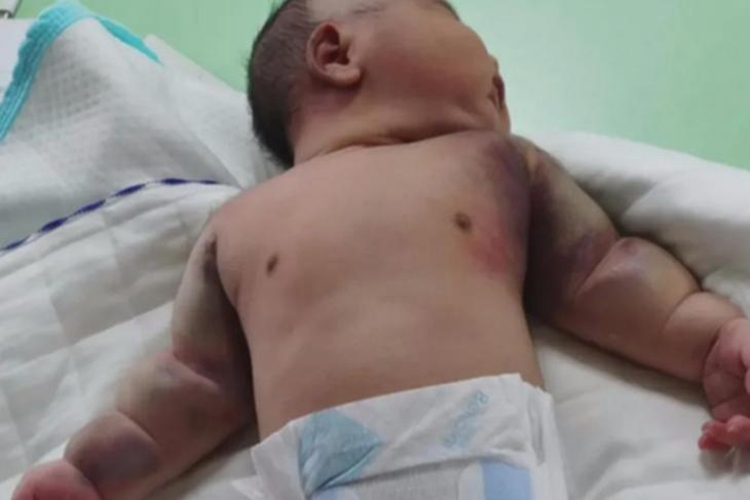 儿童白血病皮肤有瘀斑图 儿童白血病皮肤有瘀斑图