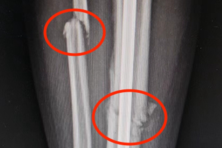 骨折小腿症状图