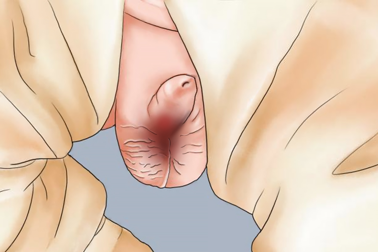 炎症后色素沉着图 炎症后色素沉着图