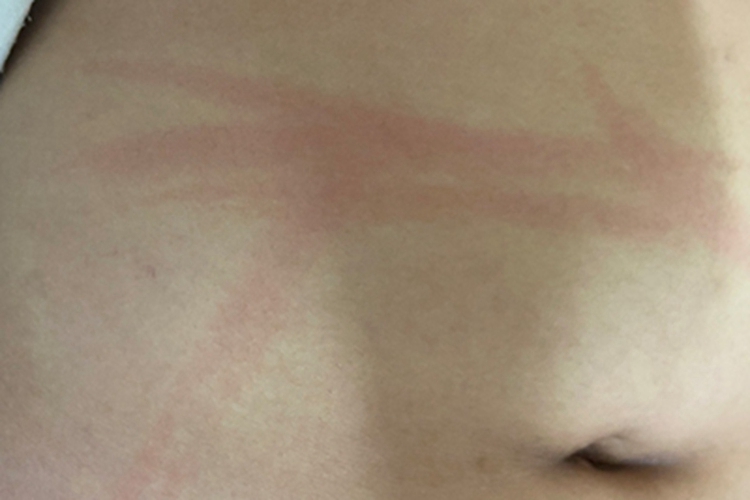 人工荨麻疹红斑图