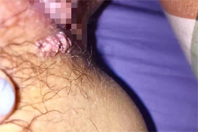 大腿根尖锐湿疣图 大腿根尖锐湿疣图