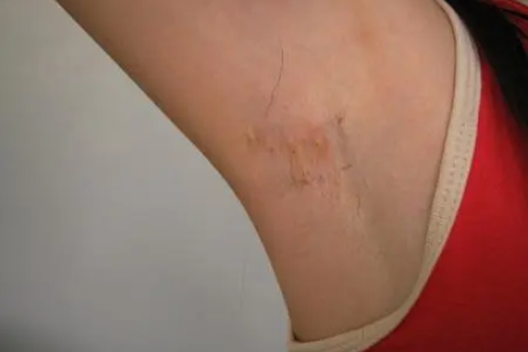 腋下祛疤修复后图 腋下祛疤修复后图