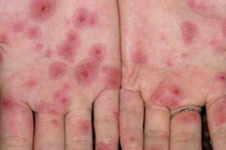 手掌二期梅毒疹图