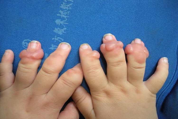 手部纤维瘤图 手部纤维瘤图