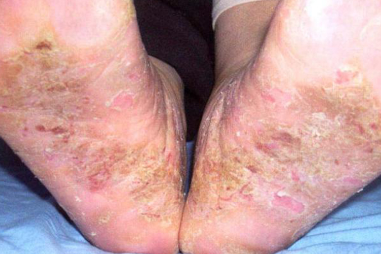 足底及足内侧缘慢性湿疹图 足底及足内侧缘慢性湿疹图