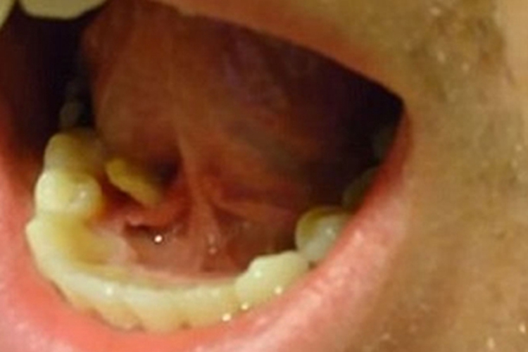 唾液腺结石病硬块图 唾液腺结石病硬块图