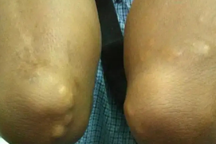 皮肤猪囊虫病结节图