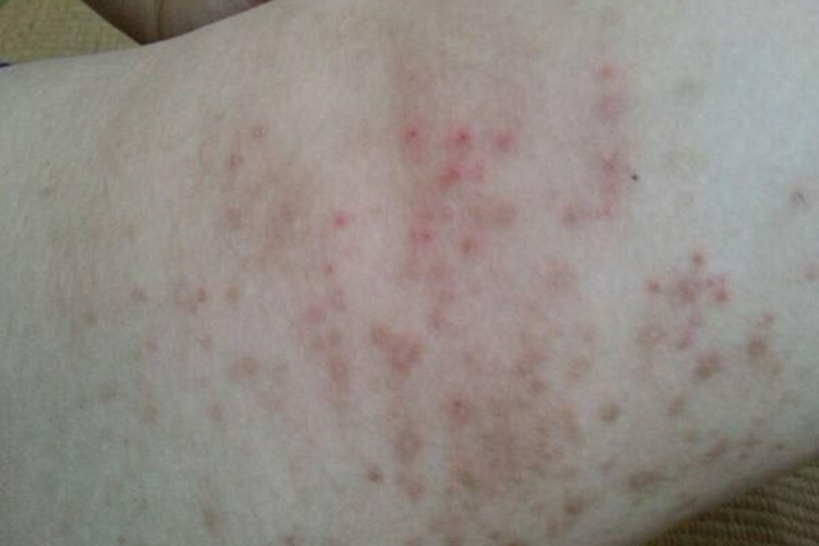 湿疹大腿内侧丘疹图