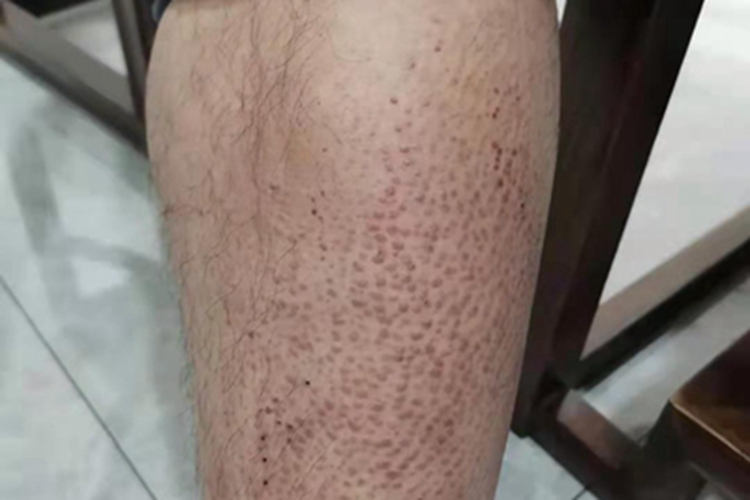 皮肤淀粉样变小腿疙瘩图 皮肤淀粉样变小腿疙瘩图