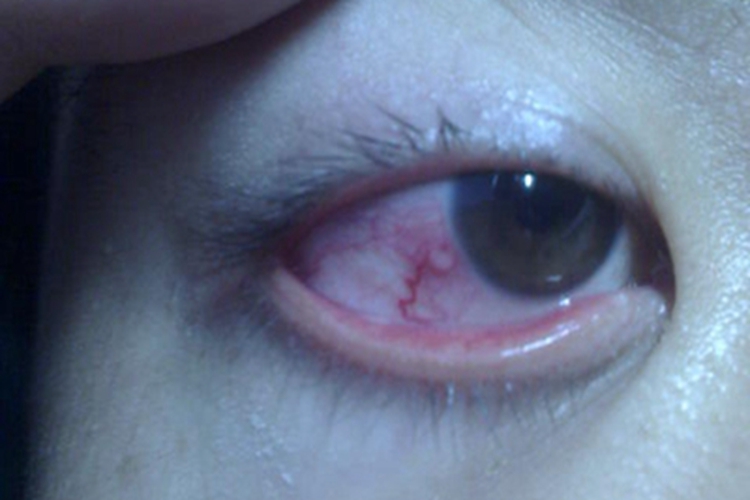 滤泡性结膜炎结膜充血图 滤泡性结膜炎结膜充血图