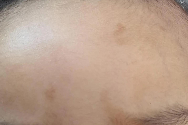 宝宝额头多发性咖啡斑图