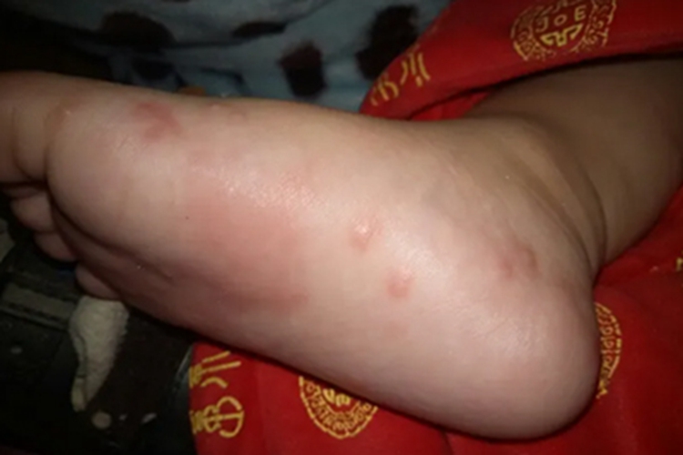 宝宝水疱型足癣图 宝宝水疱型足癣图