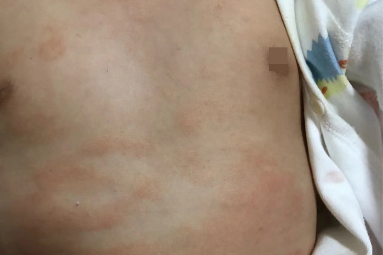 亚急性湿疹症状图