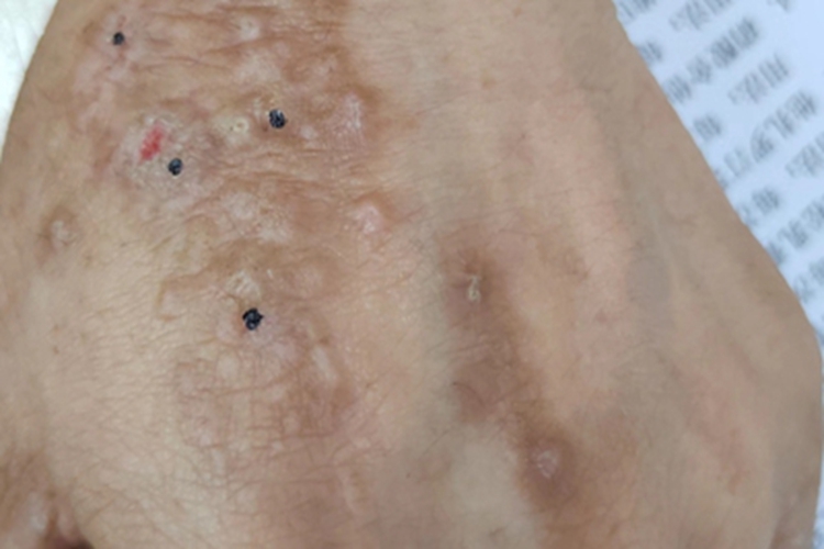 继发性皮肤淀粉样变手背疙瘩图