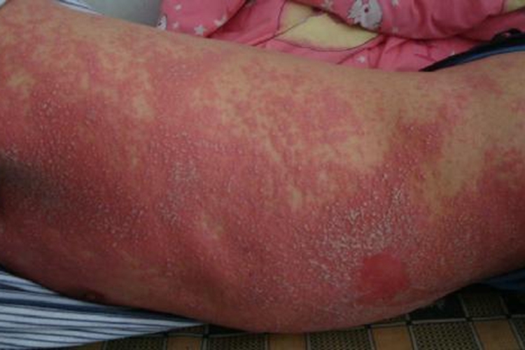 普通型猩红热有脓头图