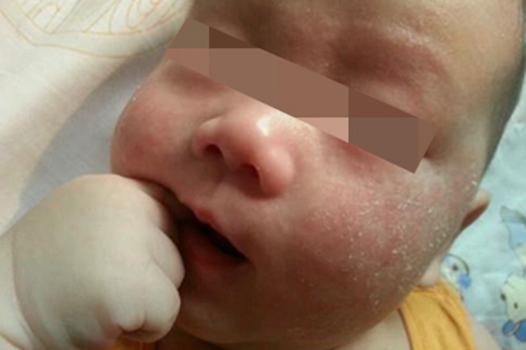 干性湿疹面部脱屑图 干性湿疹面部脱屑图