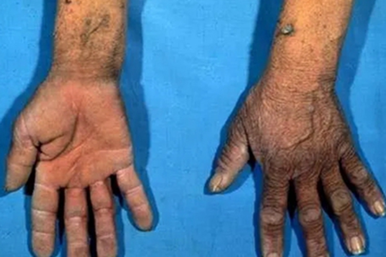 副肿瘤性天疱疮手部结节图