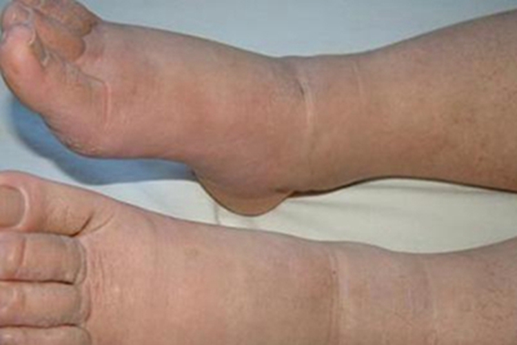 旋毛虫病双脚肿胀图