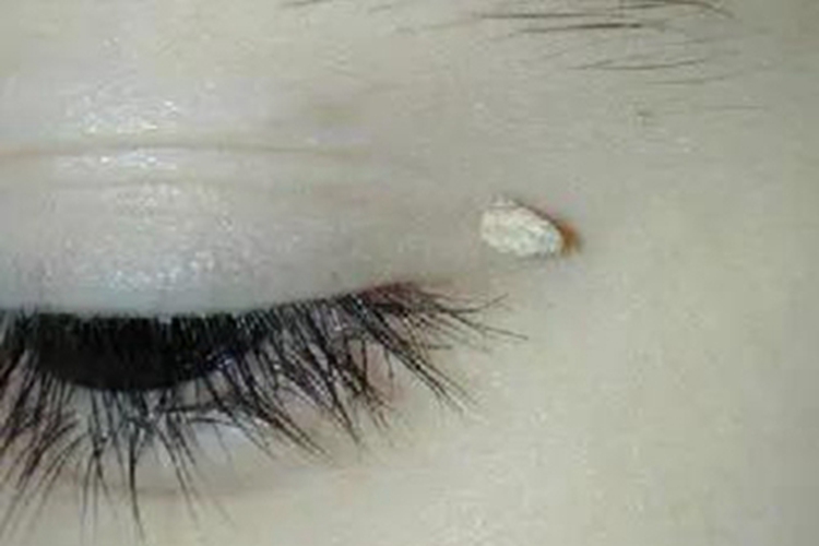 寻常疣眼周长了一个小肉粒图 寻常疣眼周长了一个小肉粒图