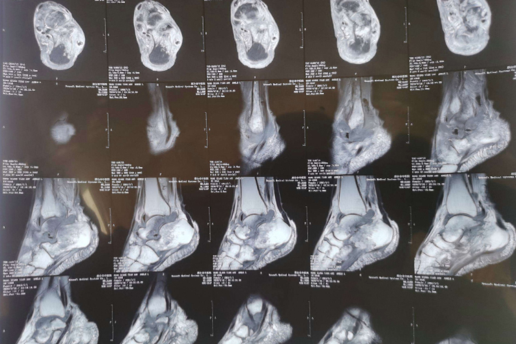 正常脚踝核磁共振图 正常脚踝核磁共振图