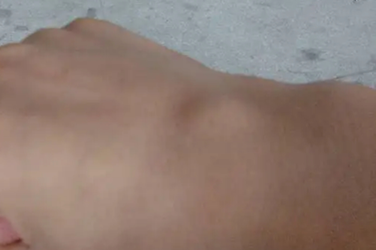 皮下脂肪瘤手背症状图