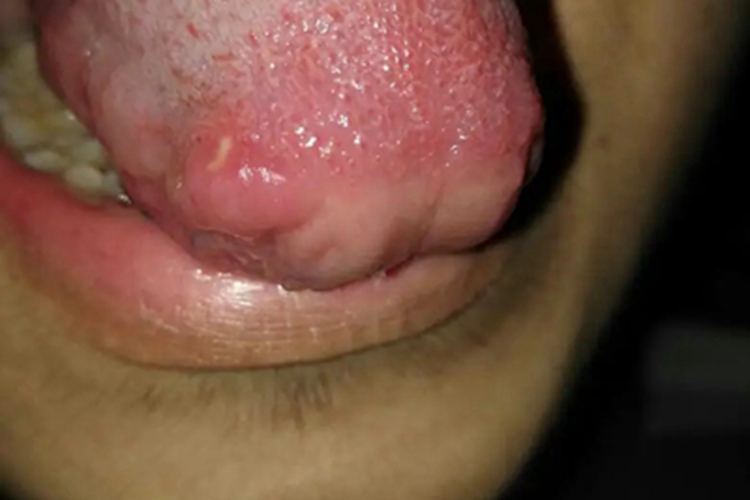 口腔带状疱疹舌头红肿图 口腔带状疱疹舌头红肿图