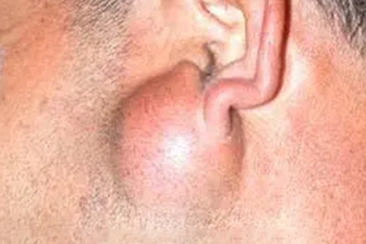 腮腺皮样囊肿症状图 腮腺皮样囊肿症状图