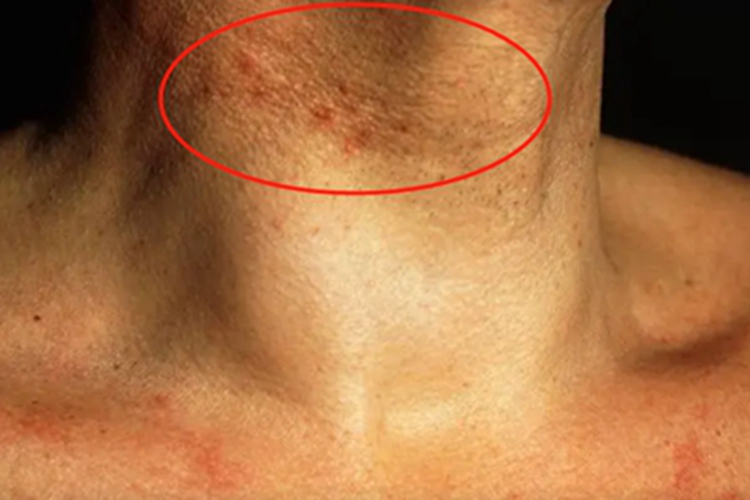 结痂性疥疮颈部丘疹图 结痂性疥疮颈部丘疹图