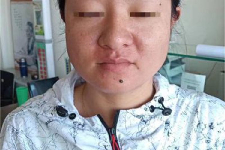 皮内痣下巴疙瘩图