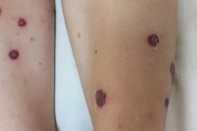 坏死性筋膜炎小腿结痂图