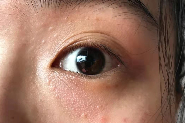 眼睑部汗管瘤图