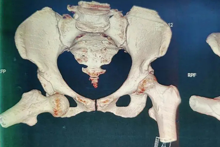 髋关节前脱位图