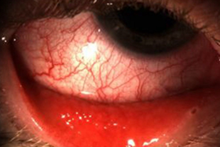 急性或亚急性细菌性结膜炎红肿图