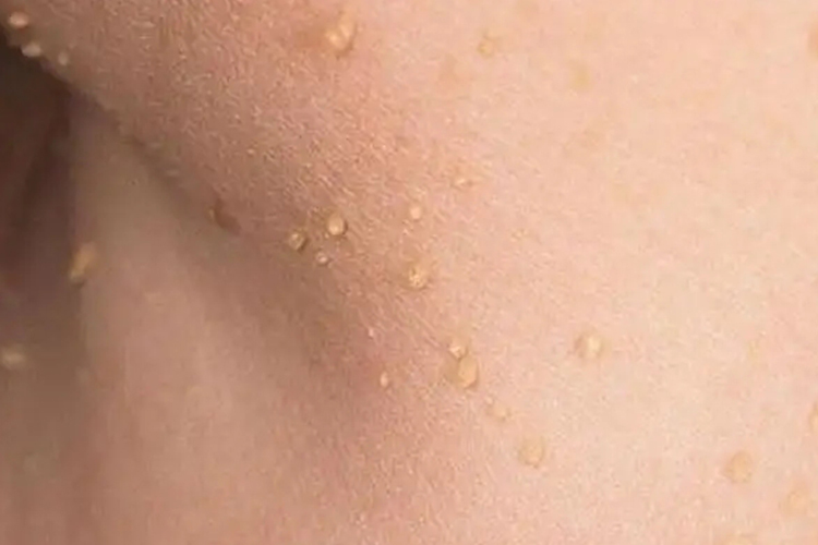 腋下寻常疣图 腋下寻常疣图