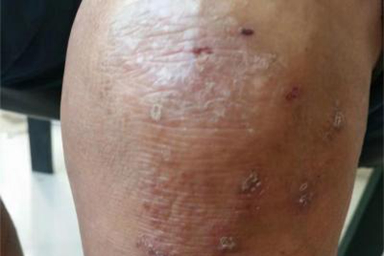 慢性湿疹膝盖皮肤增厚图